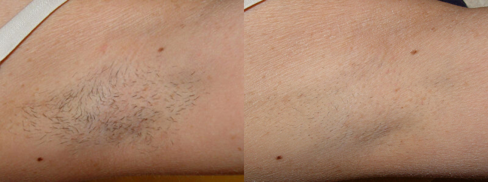 Laser Hair Removal Before and After Pictures in Houston, TX | Premier  Plastic Surgery