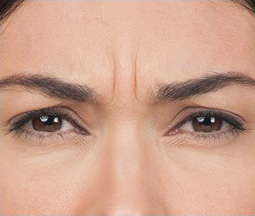 BOTOX® Cosmetic Before and After Pictures Houston, TX