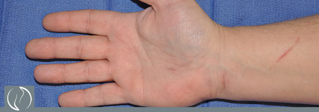Carpel Tunnel Release Surgery Before and After Pictures Houston, TX