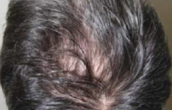 PRP Hair Loss Before and After Pictures Houston, TX