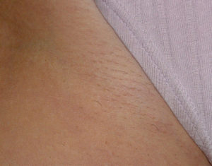 Laser Hair Removal Houston, TX - Hair Removal Pearland